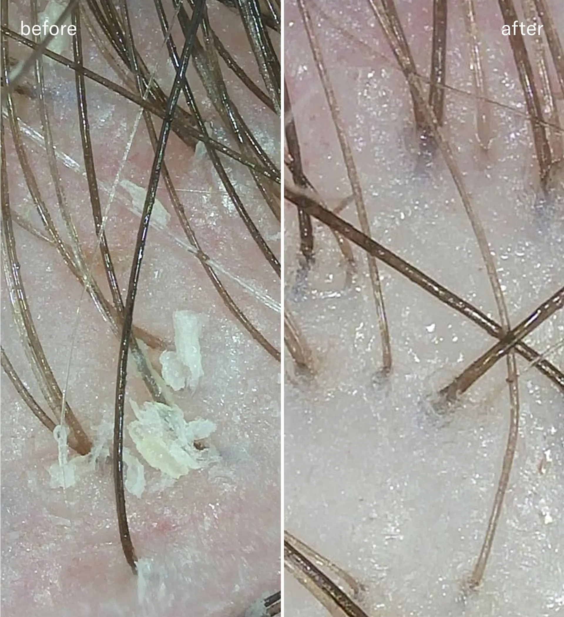 Before and after scalp clarifying shampoo